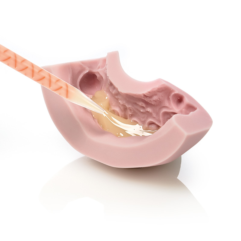 Zetalabor + Indurent gel